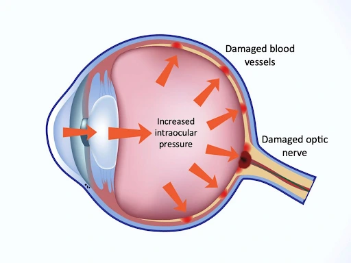 Glaucoma