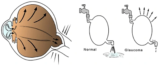 Stages-of-Glaucoma